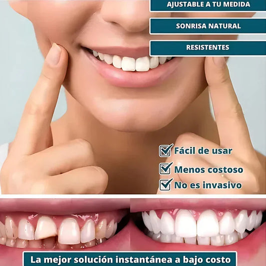 SmilePro — Carillas dentales ajustables de resina